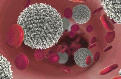 3d illustration showing the increase of non-functional white blood cells in leukaemia (blood cancer).