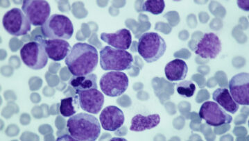 Leukemia; myeloid, 250X at 35mm. This type of leukemia has its origin in the bone marrow (myeloid tissue). It involves a malignant proliferation of immature white blood cells. This action can crowd out production of RBC s and platelets leading to anem