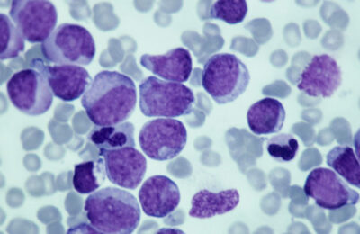 Leukemia; myeloid, 250X at 35mm. This type of leukemia has its origin in the bone marrow (myeloid tissue). It involves a malignant proliferation of immature white blood cells. This action can crowd out production of RBC s and platelets leading to anem